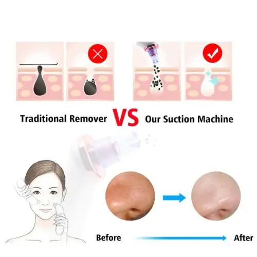 Blackhead Removal Suction Tool - Outsmart